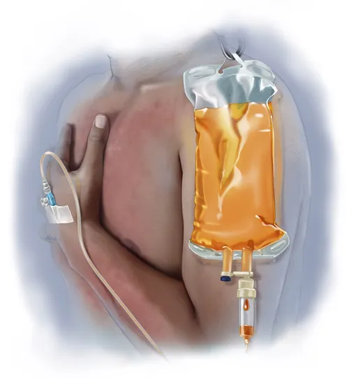 Human arm receiving IV fluid through medical tubing
