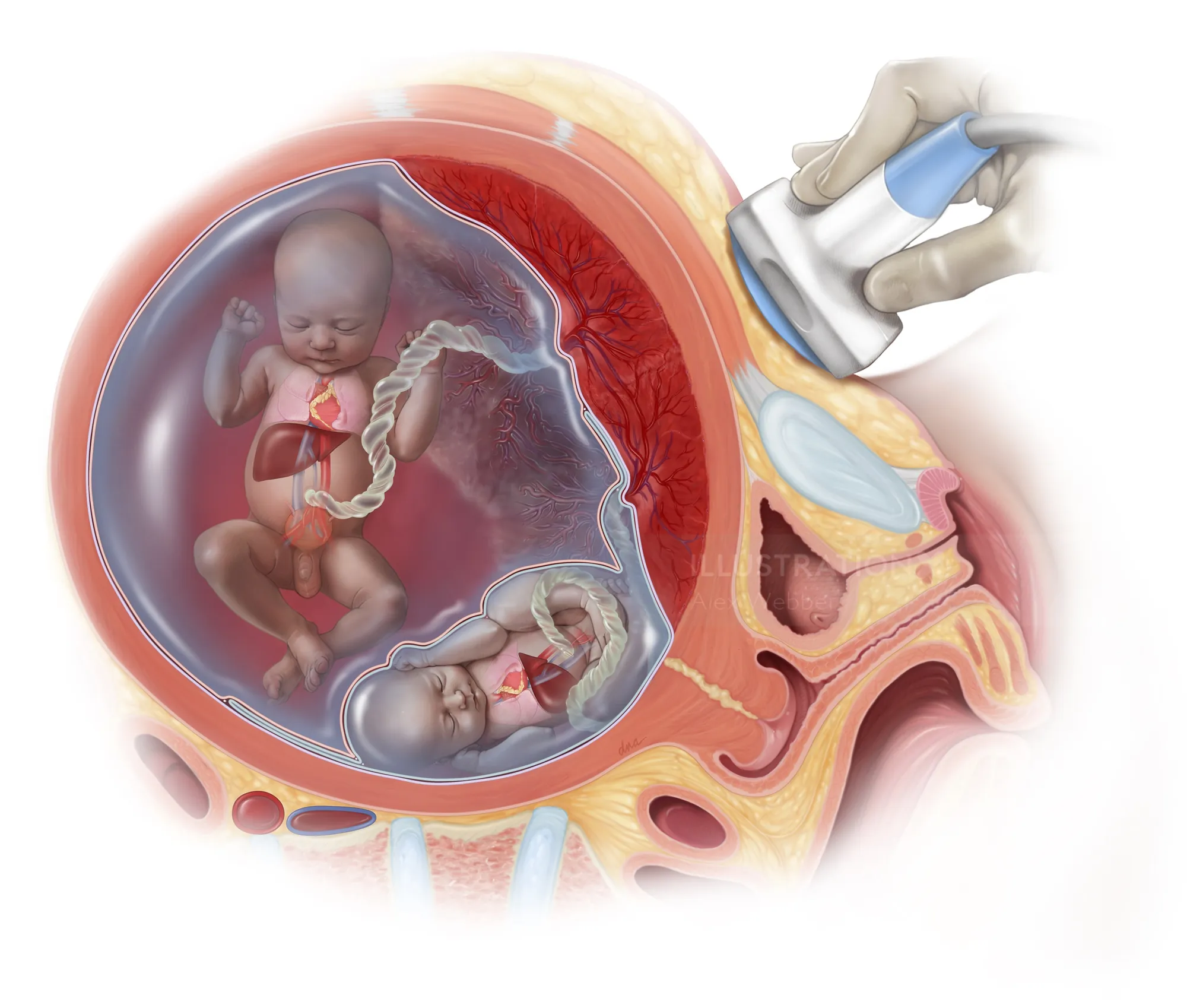 Ultrasound scan of twin fetuses inside the womb by Alex Webber