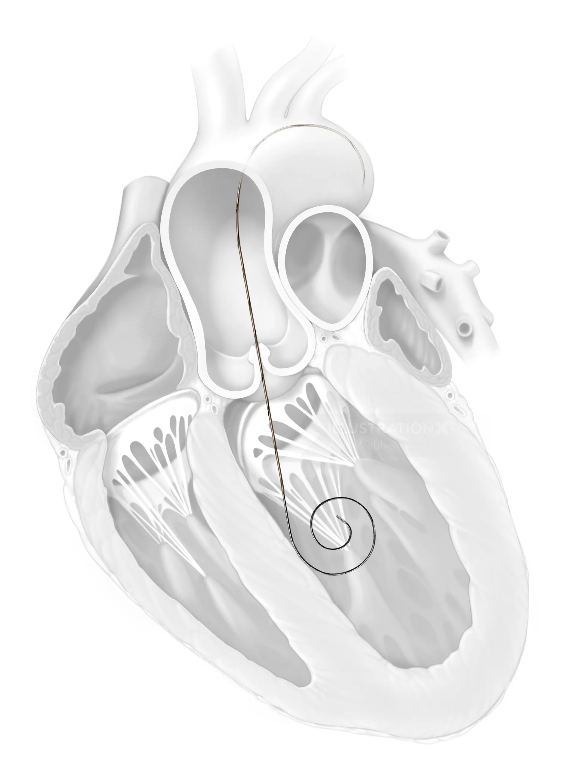 Anatomical heart diagram with internal chambers and pacing lead wire, by Alex Webber