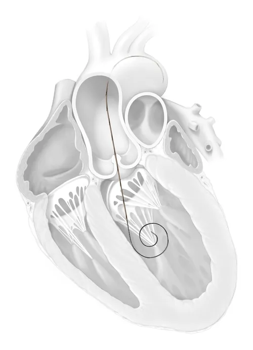 Anatomical heart diagram with internal chambers and pacing lead wire, by Alex Webber