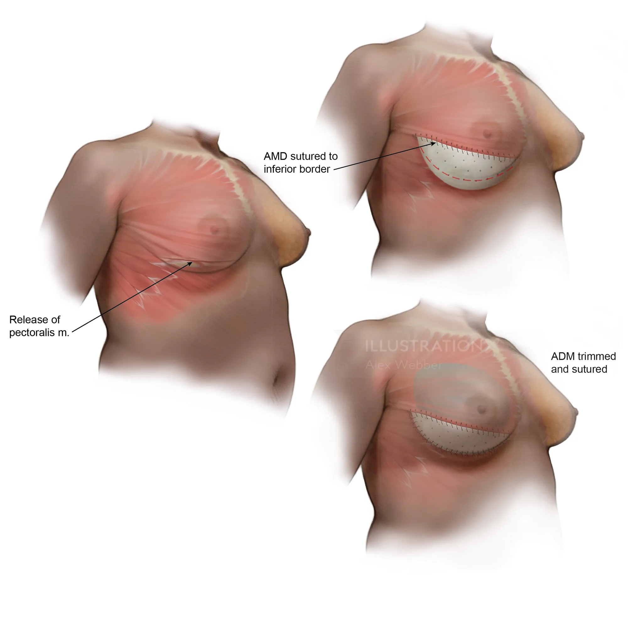 Medical illustration of pectoralis muscle release and ADM placement by Alex Webber