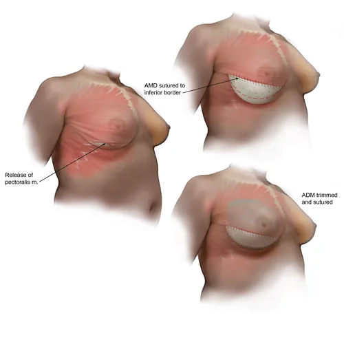 Medical illustration of pectoralis muscle release and ADM placement by Alex Webber