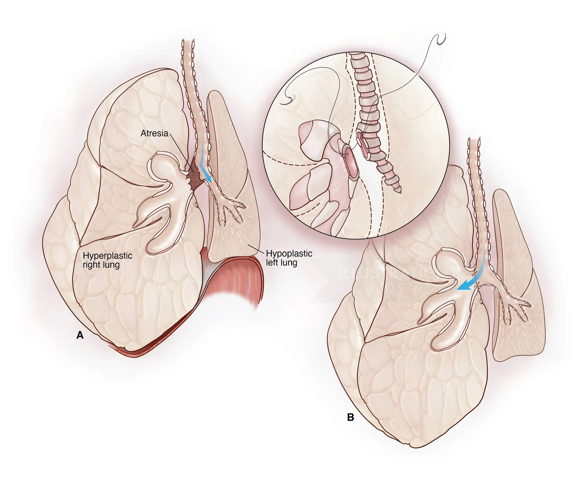 Medical diagram showing hypoplastic and hyperplastic lungs with atresia by Alex Webber