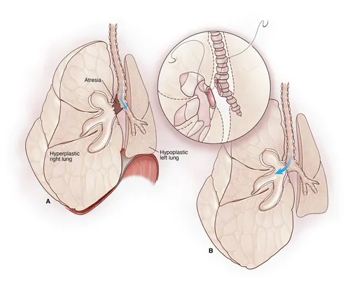 Medical diagram showing hypoplastic and hyperplastic lungs with atresia by Alex Webber