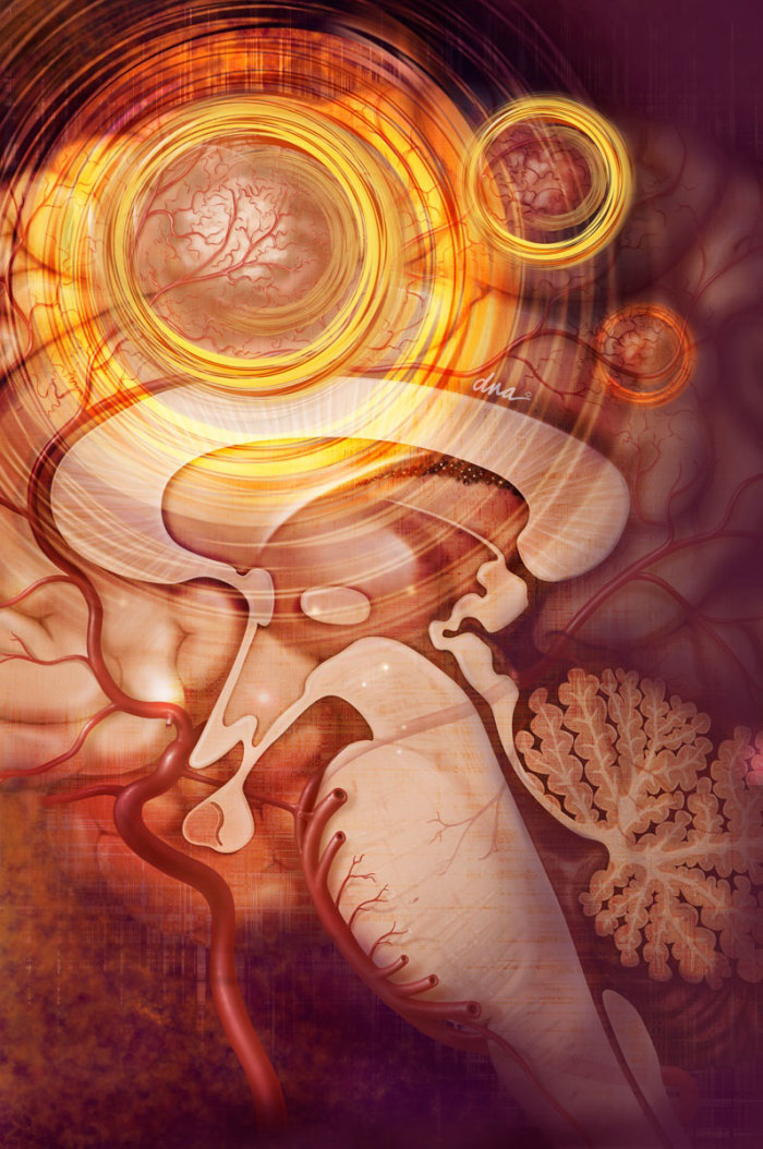 Editorial illustration of brain with metastatic cancer