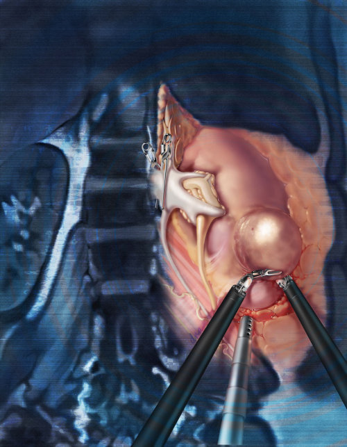 显示机器人部分肾切除术的插图