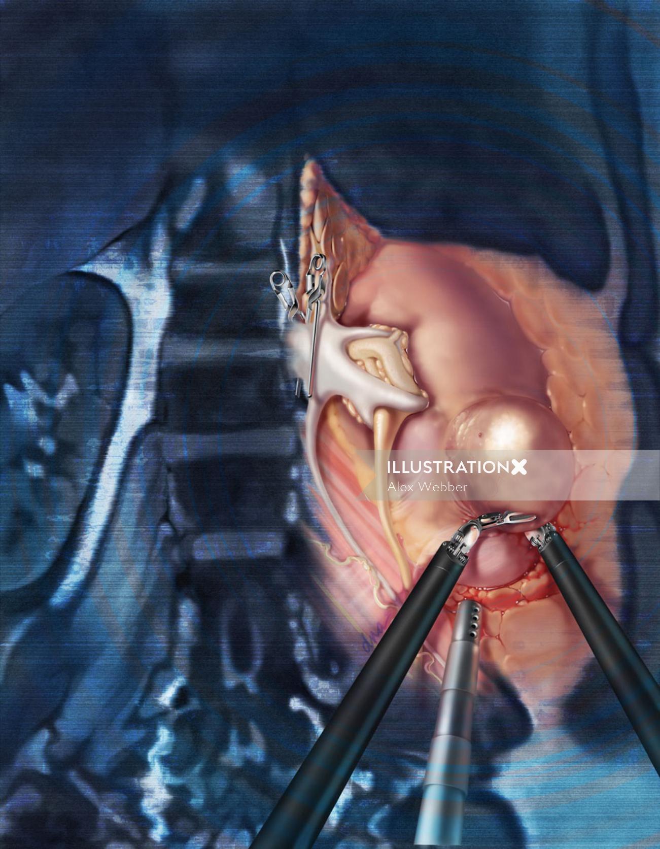 Ilustração mostrando a nefrectomia parcial robótica