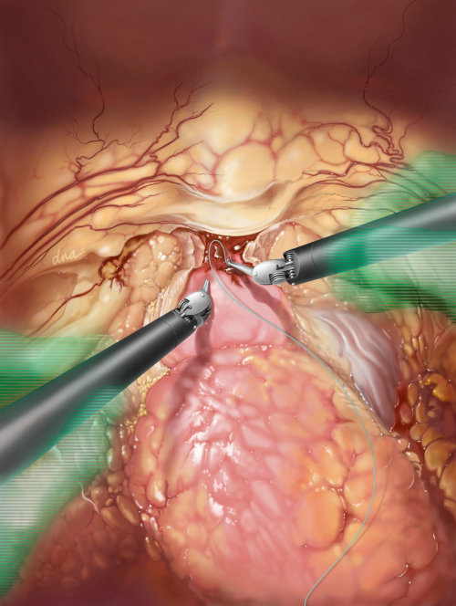 Prostatectomy surgery illustration by AlexBaker