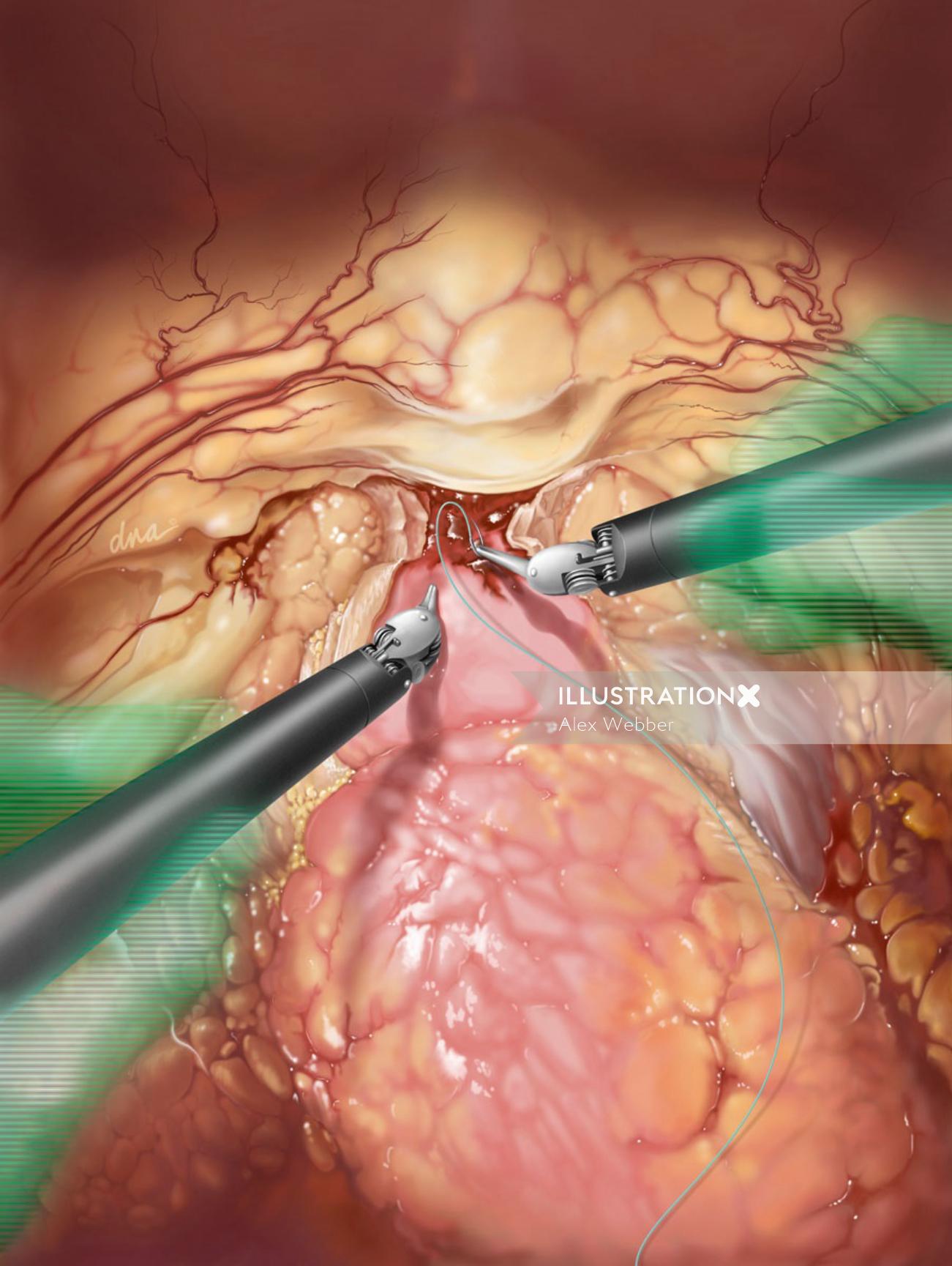 Ilustração de cirurgia de prostatectomia por AlexBaker