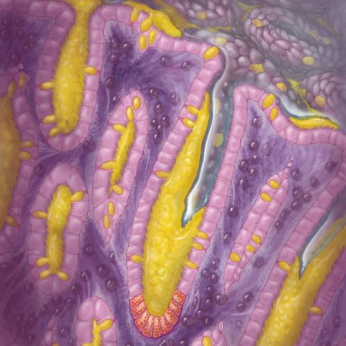 Realistic artwork of large intestine histology showing mucositis
