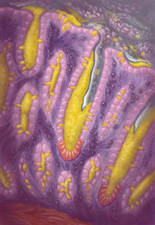 Realistic artwork of large intestine histology showing mucositis