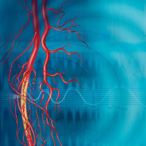 Peripheral arterial disease illustration by AlexBaker