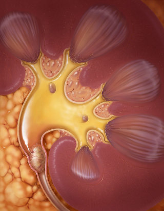 Ilustração médica mostrando pedra nos rins