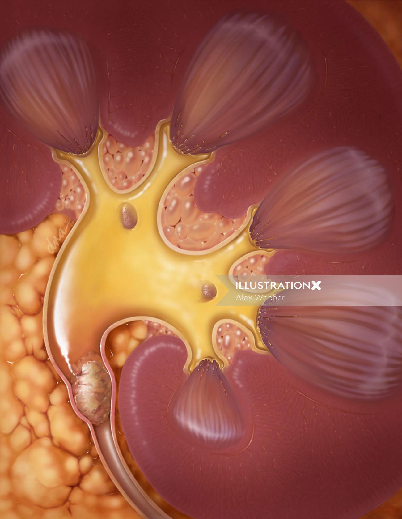 Uma ilustração da pedra nos rins no ureter proximal