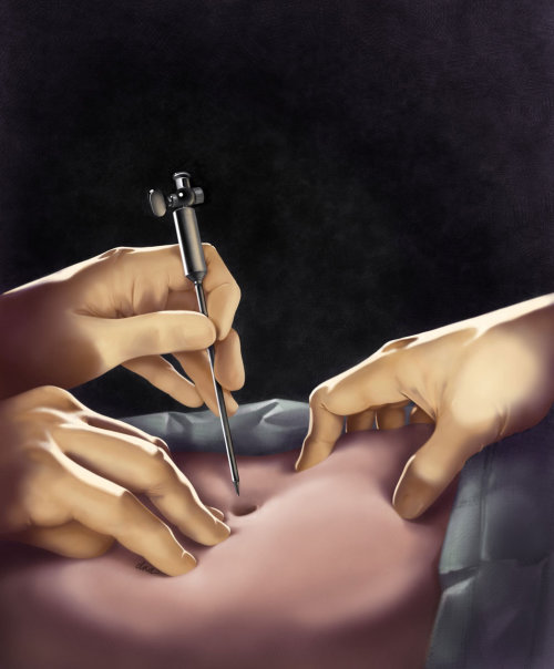 Abdominal laparoscopic surgery illustration