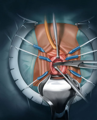ilustración técnica de reparación de malla vaginal