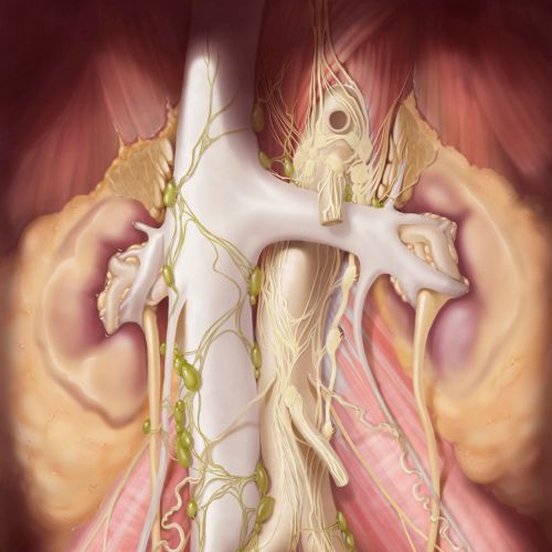 Digital artwork of Retroperitoneal lymph node dissection