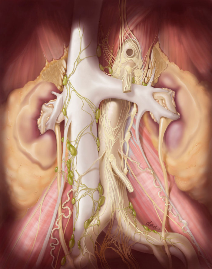 Digital artwork of Retroperitoneal lymph node dissection