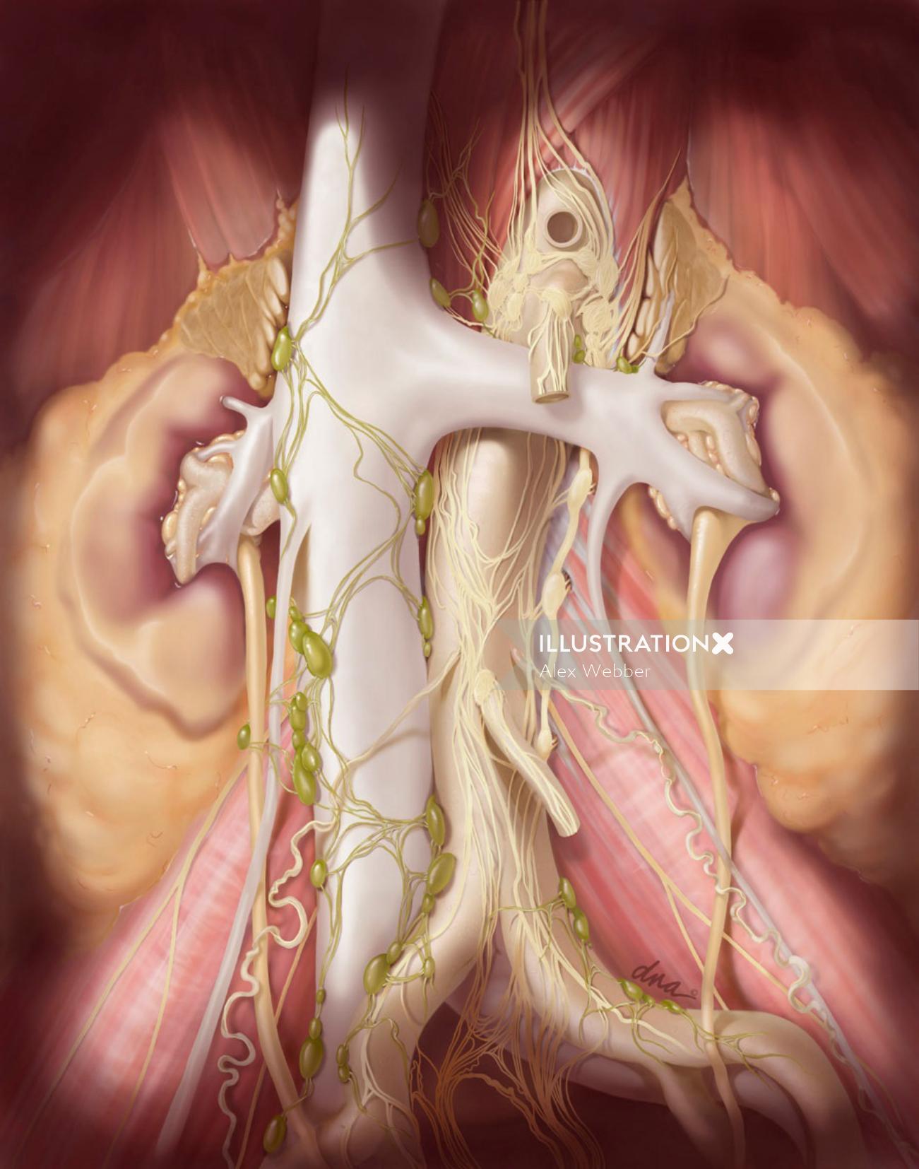 Ilustração de dissecção de linfonodo retroperitoneal