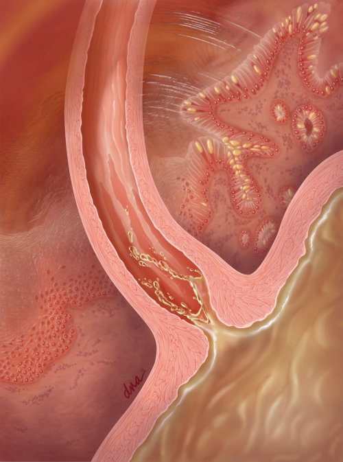 gastroesophageal reflux illustration by alexbaker