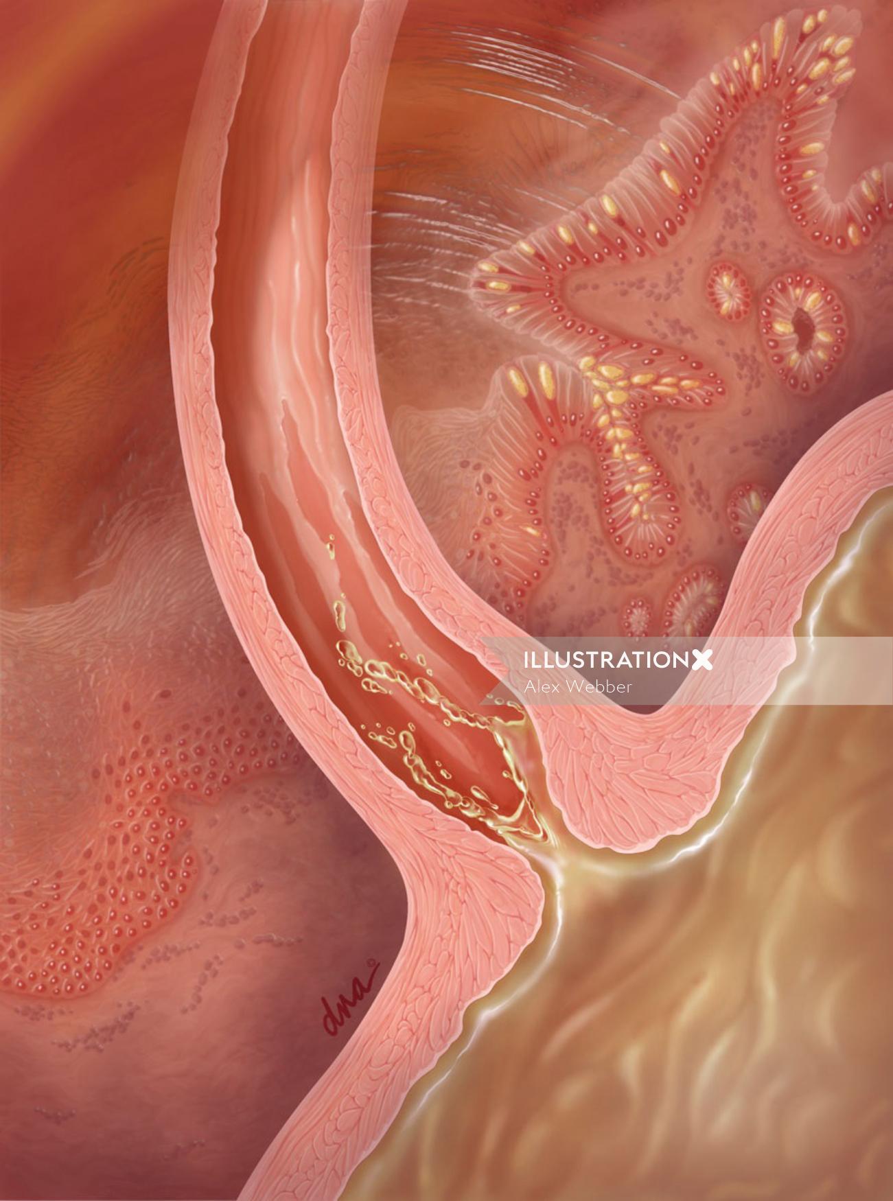 Illustration de reflux gastro-œsophagien par AlexBaker