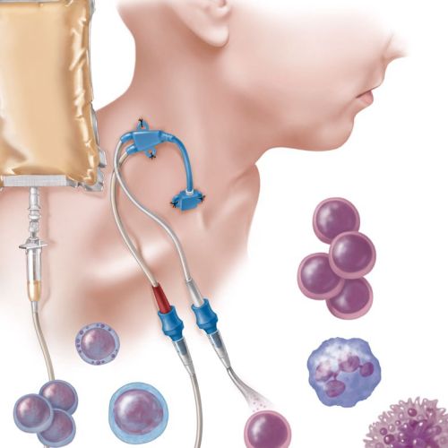 Hematopoietic stem cell transplant illustration by AlexBaker