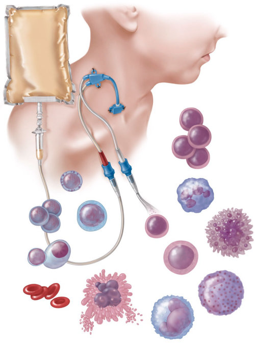 autologous stem cell transplant process