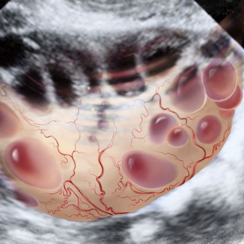 Polycystic Ovary scanning informative illustration