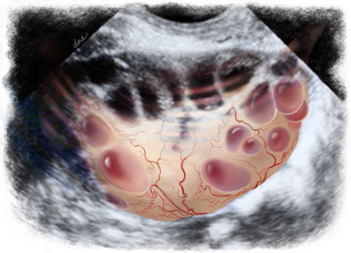 An illustration of polycystic ovary