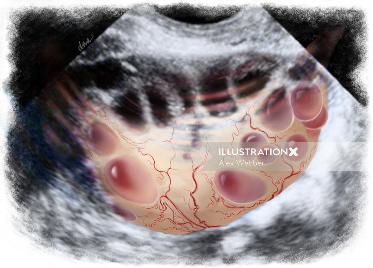 多嚢胞性卵巣スキャン有益なイラスト
