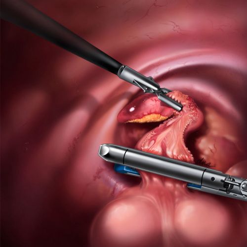 An illustration of Laparoscopic appendectomy