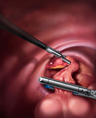 Cirugía laparoscópica de apendicectomía fotorrealista