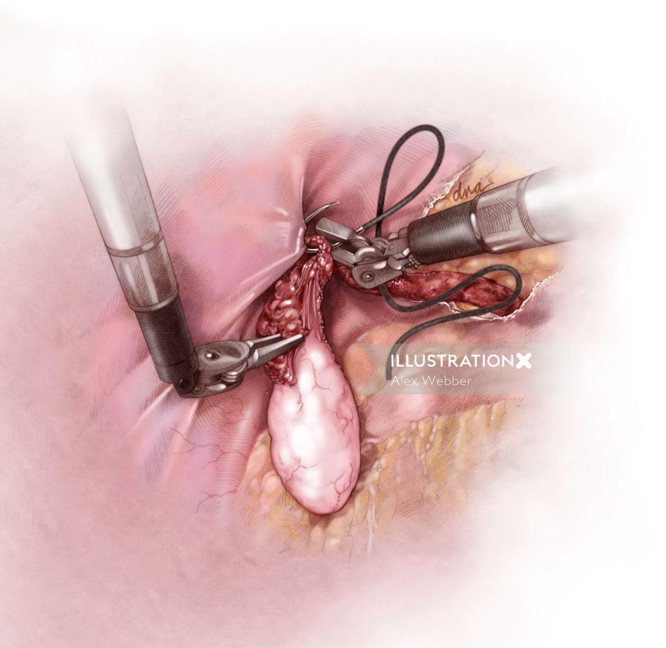 Transposição ovariana da ilustração da fertilidade por AlexBaker