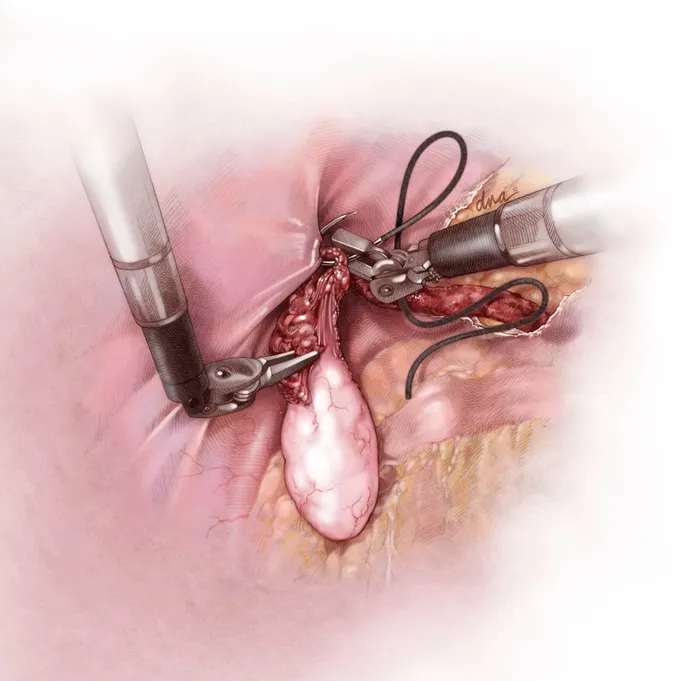 Visual realism of ovarian transposition for fertility preservation