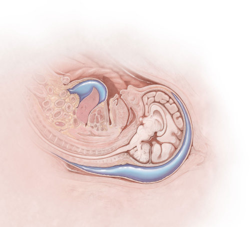 Concept art of Fetal Hydrops for Medical Magazine by Alex Webber