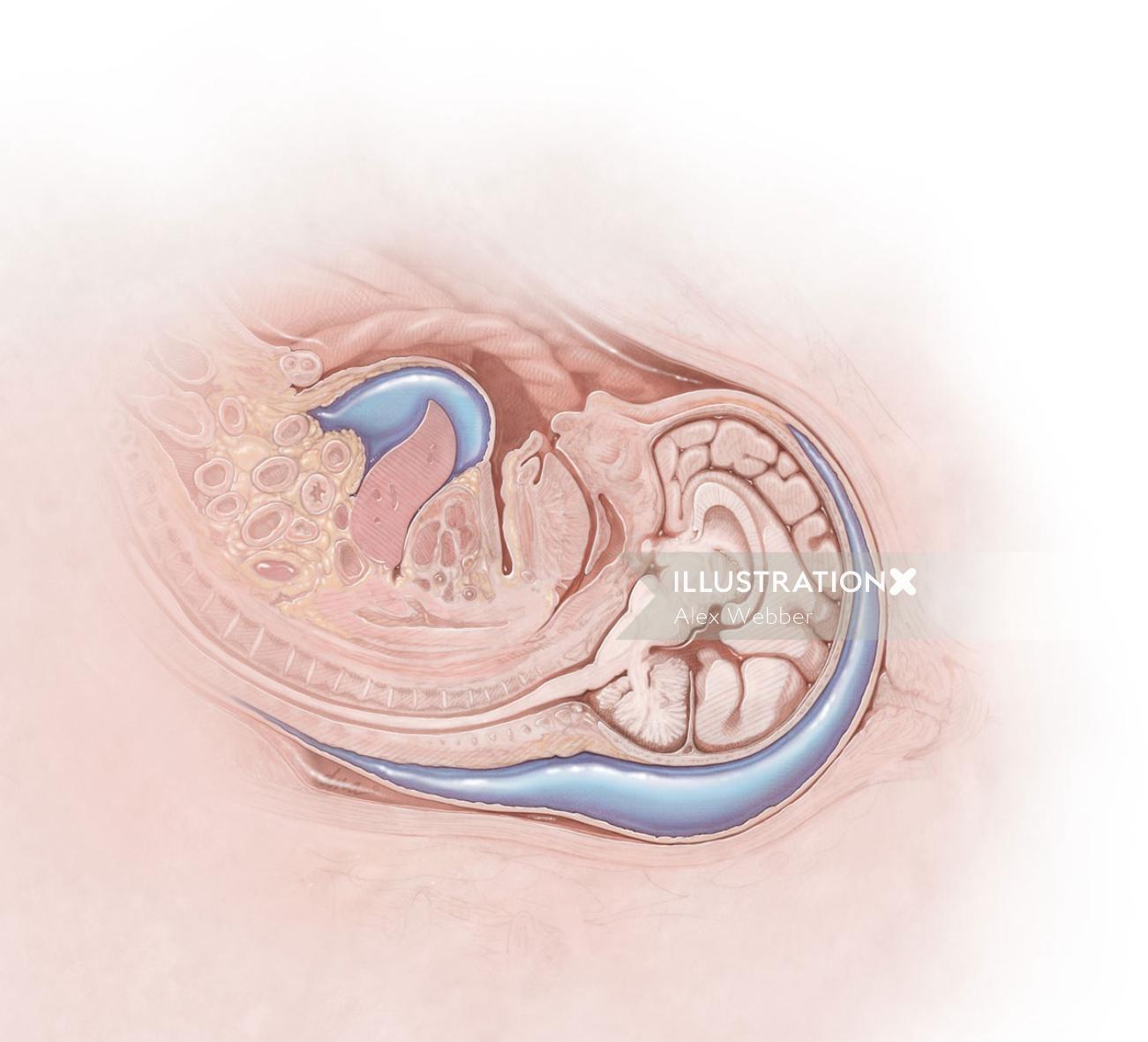 Arte conceitual do Fetal Hydrops for Medical Magazine por Alex Webber