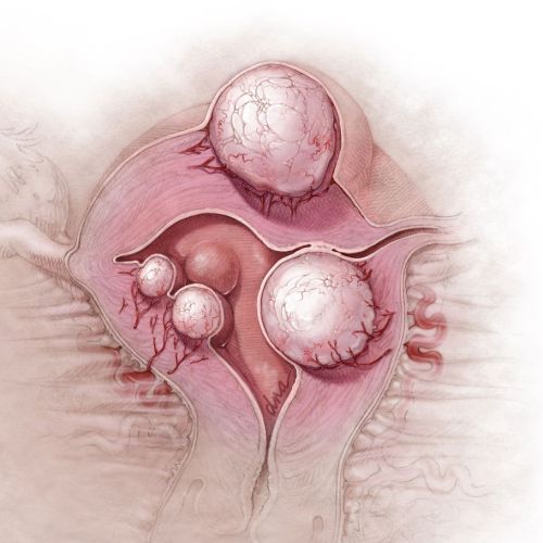 Uterine fibroids illustration by AlexBaker