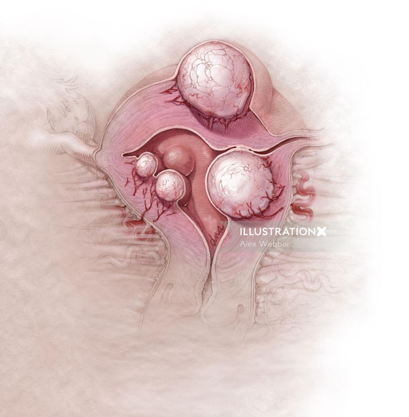 Ilustração de miomas uterinos por AlexBaker