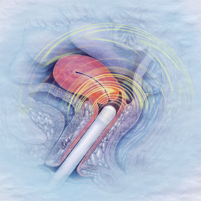 Post-menopausal bleeding Ultrasound screening illustration