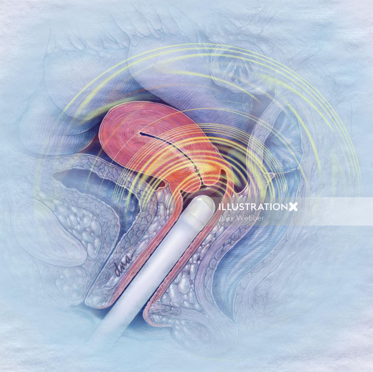 Ilustração de triagem de ultrassom de sangramento pós-menopausa