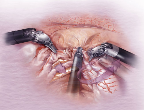 Ureter laparoscopic Surgery technical illustration