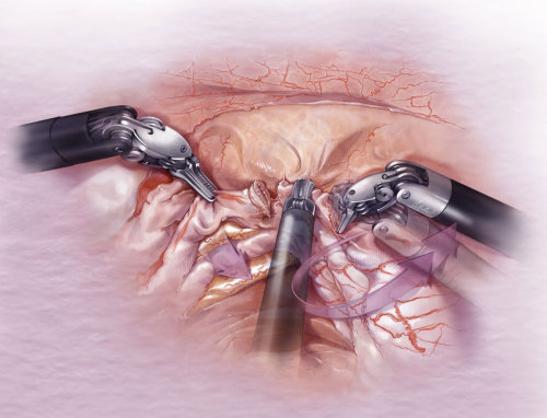 Uterine artery surgery illustration by AlexBaker