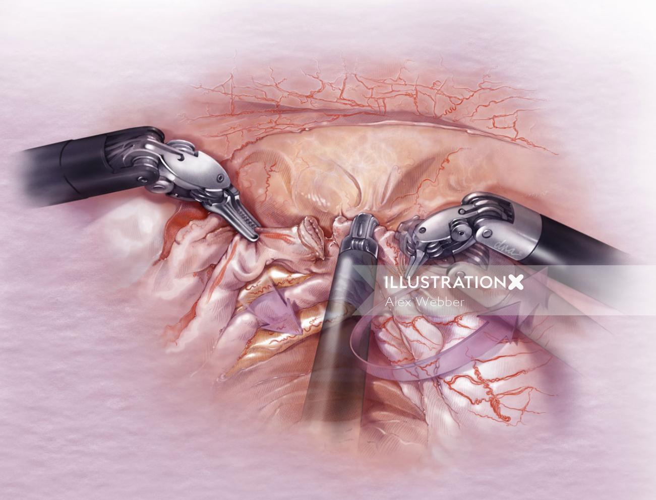 Ilustração técnica da cirurgia laparoscópica do ureter