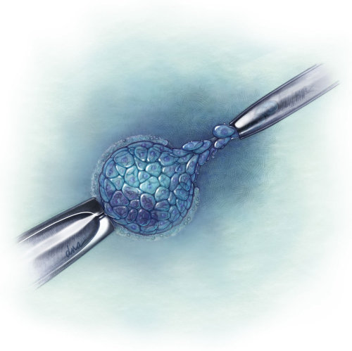 IVF Trophoectoderm transfer illustration by AlexBaker