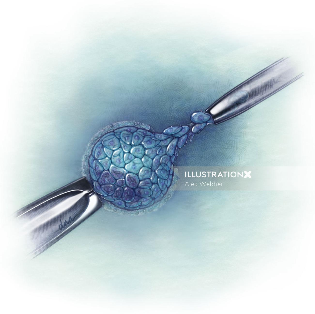Ilustração de transferência de Trophoectoderm de fertilização in vitro por AlexBaker