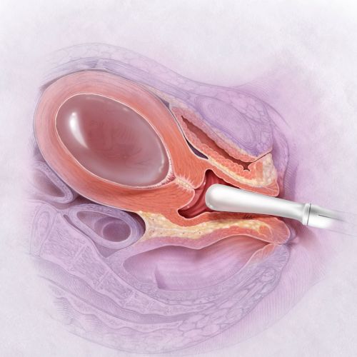Vaginal ultrasound screening at 15/16 weeks pregnancy