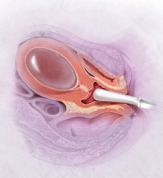 Triagem ultrassonográfica vaginal com 15/16 semanas de gravidez
