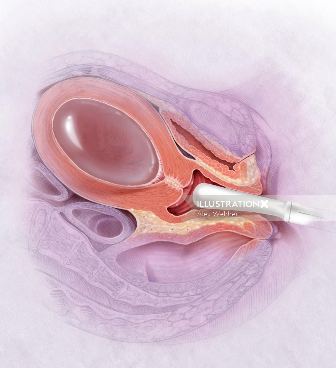 Ilustração do colo do útero curto por AlexBaker