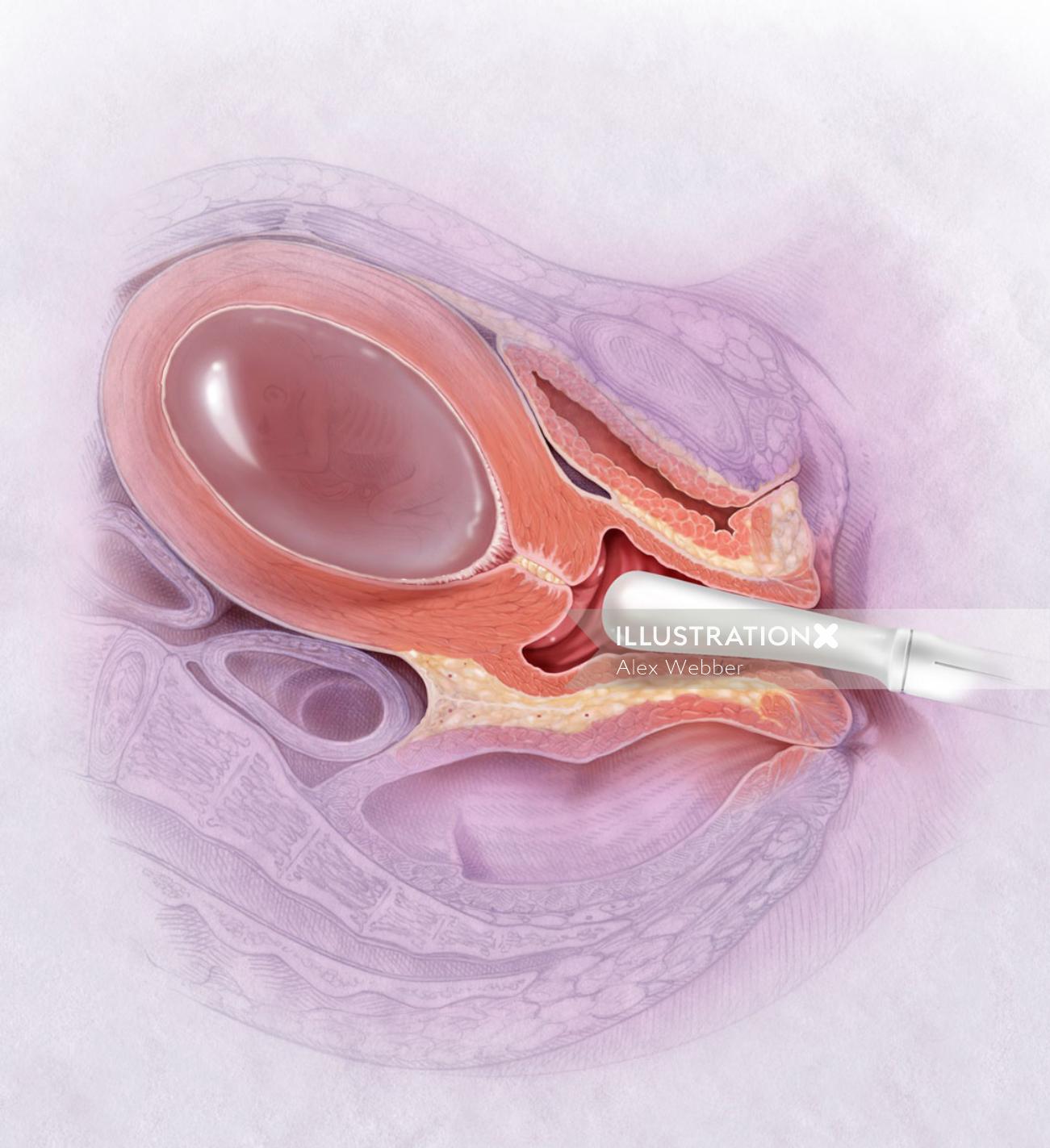 Ultrassonografia vaginal com 15/16 semanas de gravidez