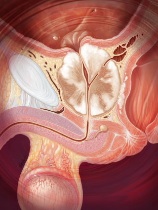 Ilustração mostrando câncer de próstata